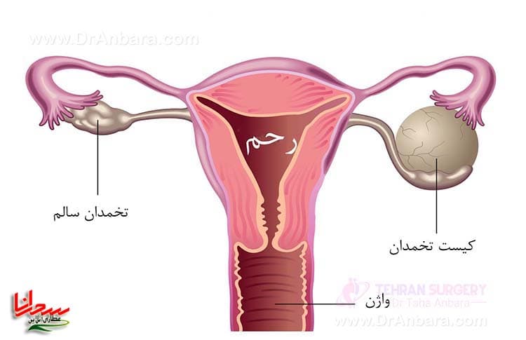 کیست تخمدان هموراژیک یا کیست خونی