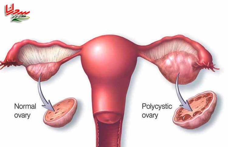 انواع کیست تخمدان : کیست پارااوارین (Para ovarian cys)