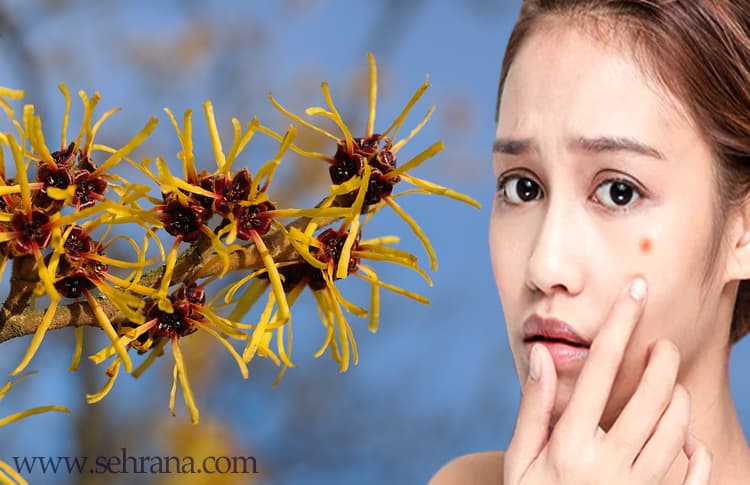 چگونه از فندق افسون گر برای مقابله با پوست مستعد آکنه استفاده کنیم