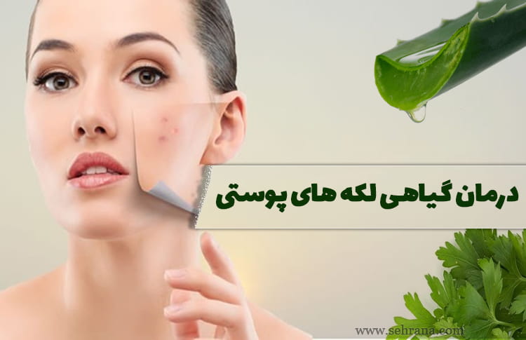 درمان گیاهی لکه های پوستی