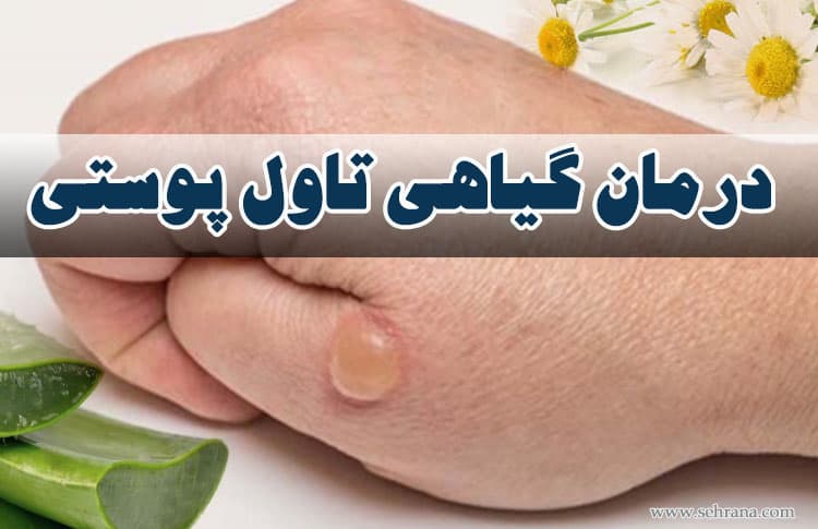 درمان گیاهی تاول پوستی
